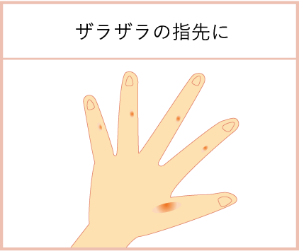 手指がザラザラ