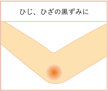 ひじ・ひざが黒ずんでいる