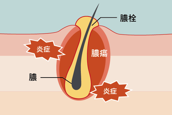 癤(せつ)または疔(ちょう)